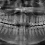 Black and white panoramic X-ray showing 4 wisdom teeth that need removal