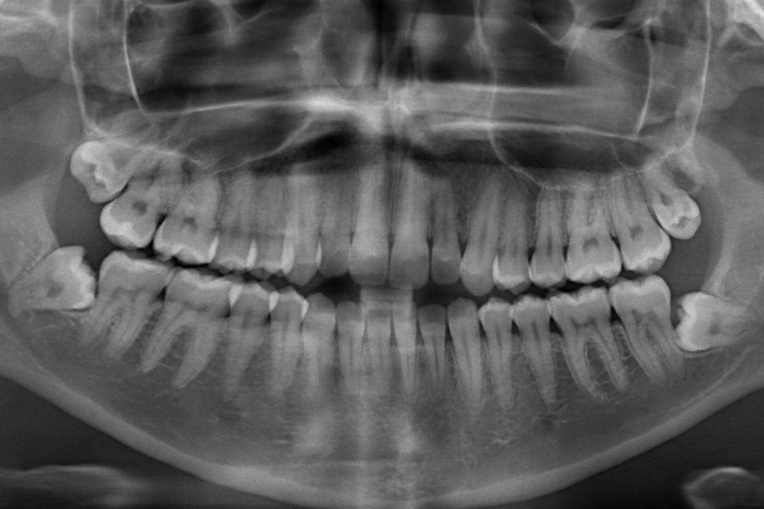 Black and white panoramic X-ray showing 4 wisdom teeth that need removal