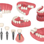 Drawings of different dental implant configurations to replace missing teeth in Dallas, TX