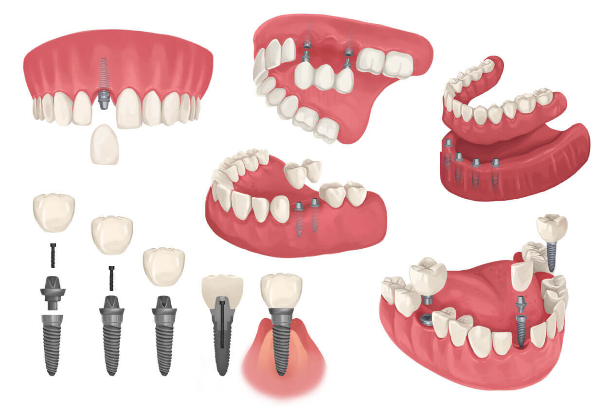 Drawings of different dental implant configurations to replace missing teeth in Dallas, TX